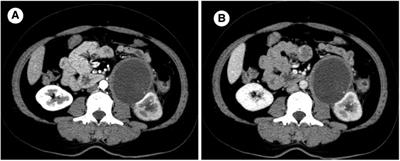 Case report and literature review: Robot-assisted laparoscopic left renal mucinous cystadenocarcinoma radical nephrectomy